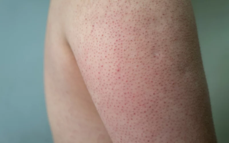 Keratosis Pilaris