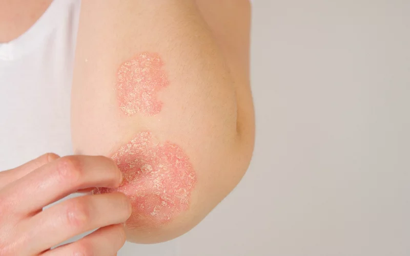 Psoriasis