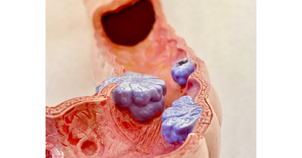 Polyps