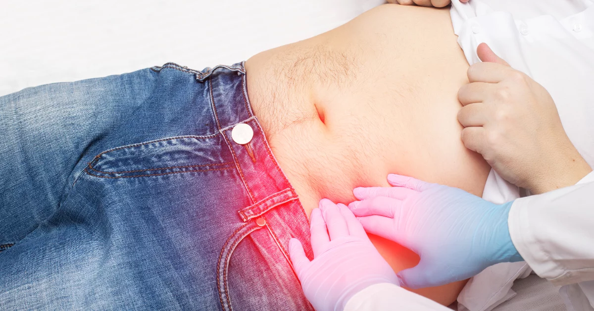 Diverticulosis