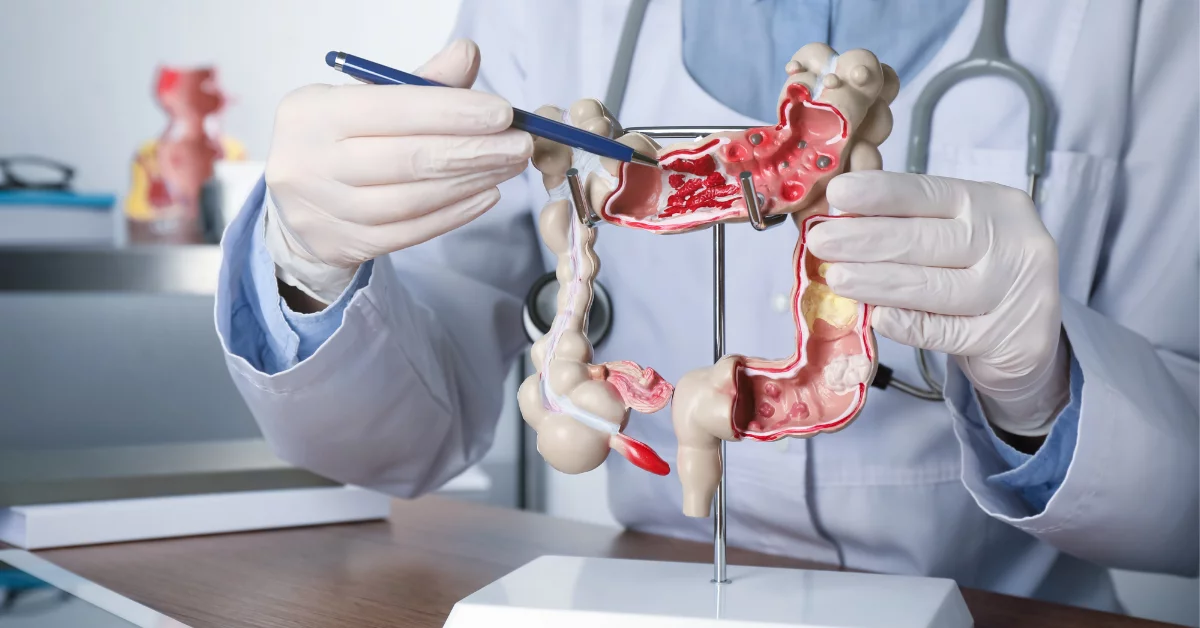 Colon Cancer
