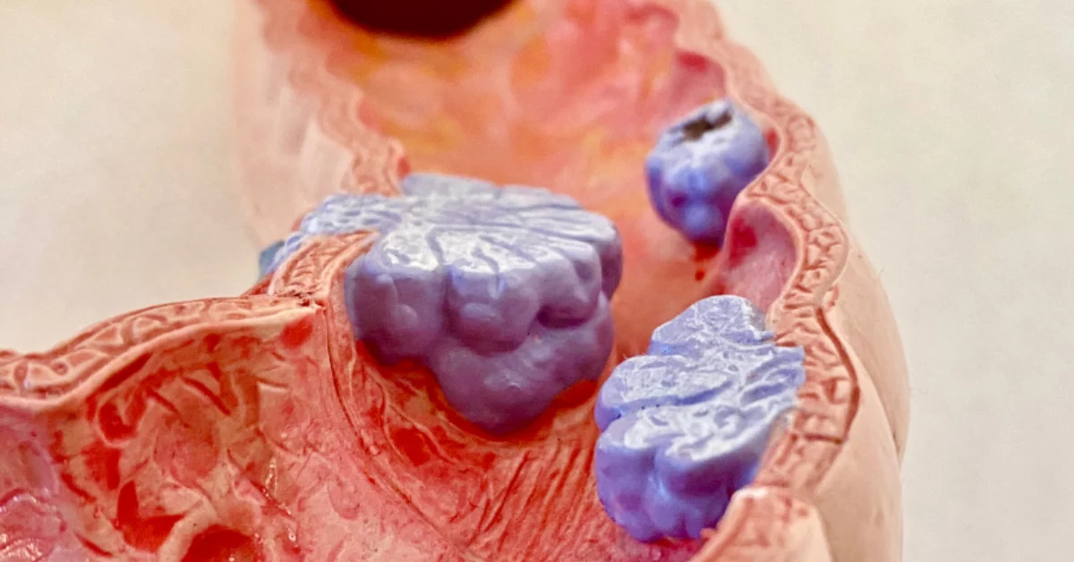 Polyps