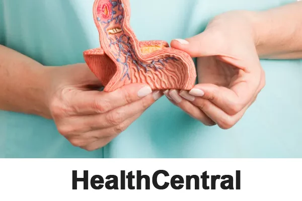 heartburn, Erosive Esophagitis