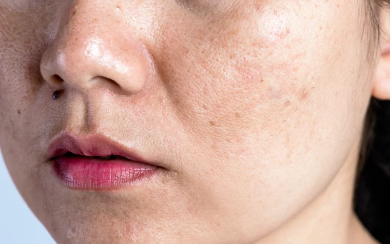 Acne Scars