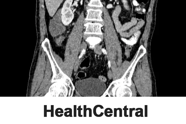 CT Scan