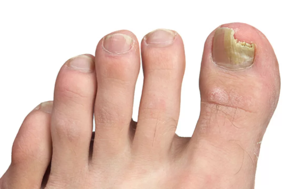 Fungal Nail Infection