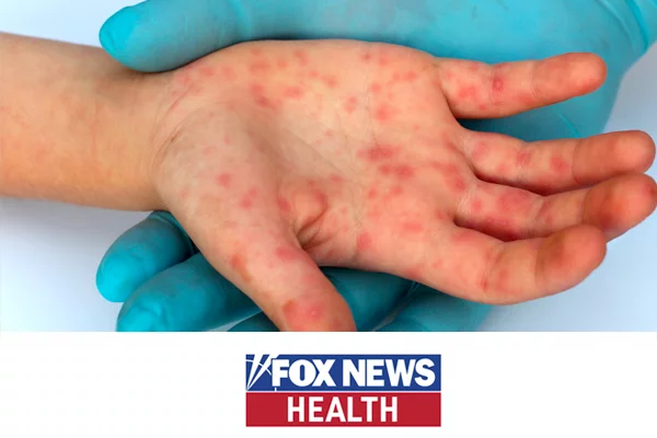 Measles more likely to be severe among malnourished