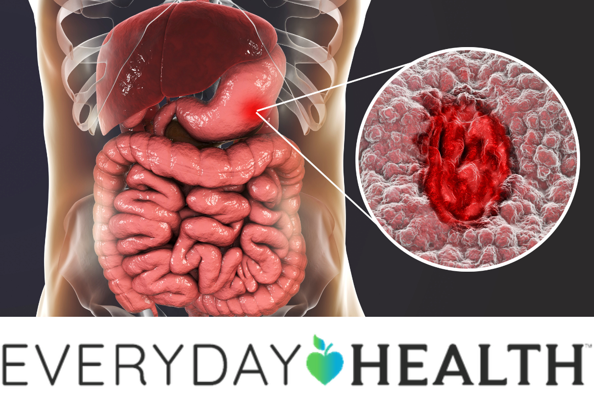 5 Early Signs and Symptoms of Ulcerative Colitis